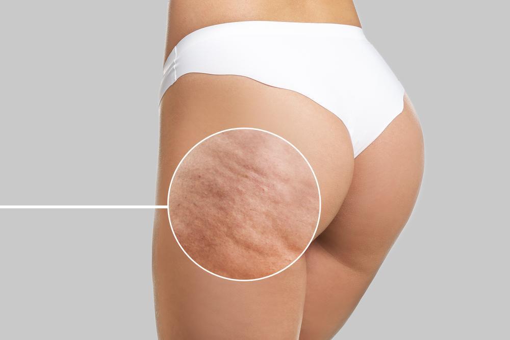 Reduce cellulite and inches with Red Light Therapy