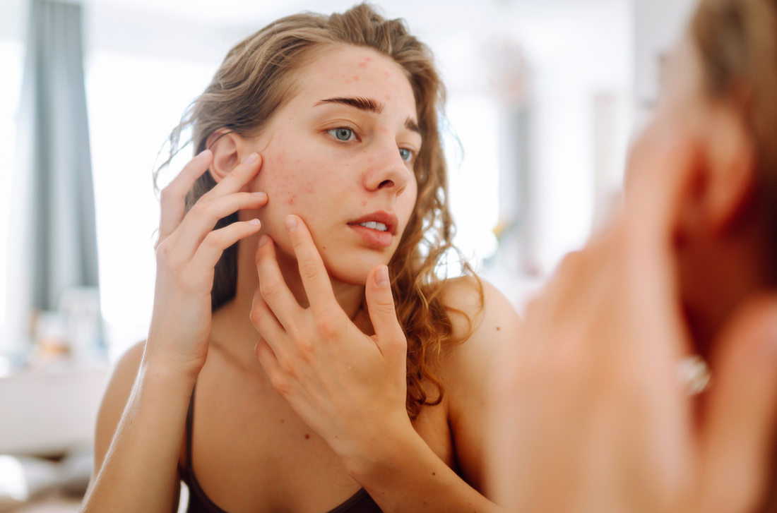 Recommended Red Light Therapy Wavelengths for Acne