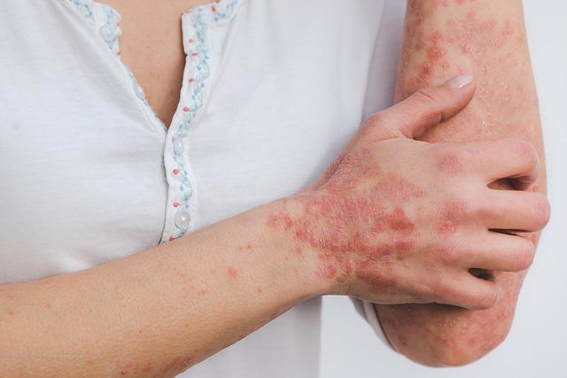 A person suffering from psoriasis