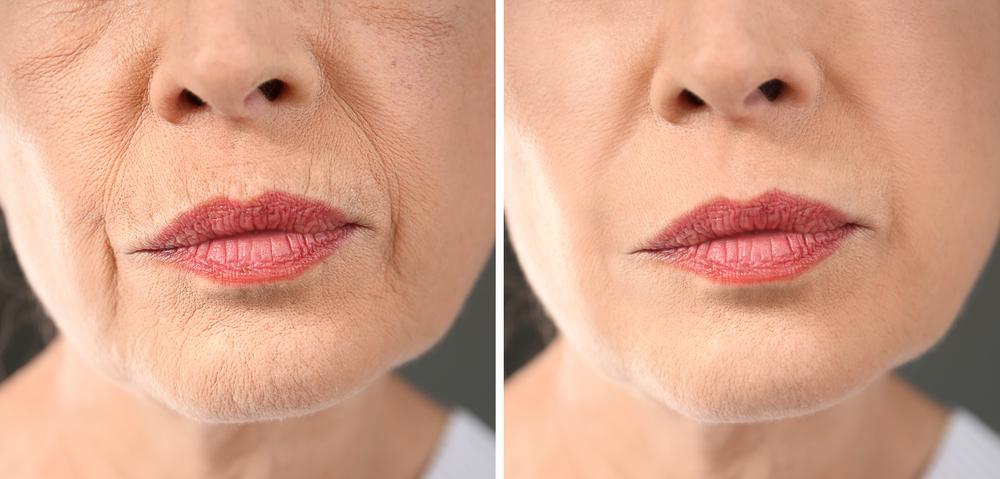 Red Light Therapy for Wrinkles