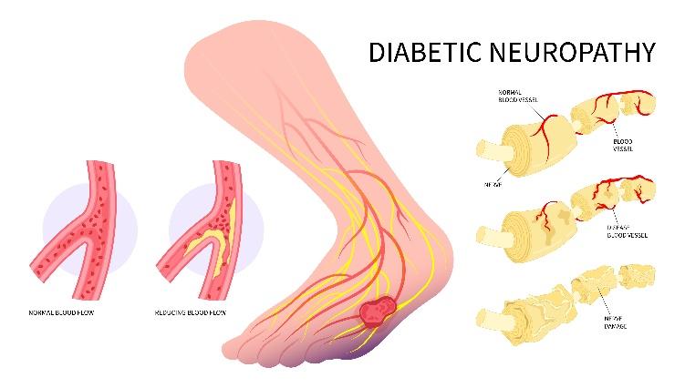An illustration of diabetic neuropathy