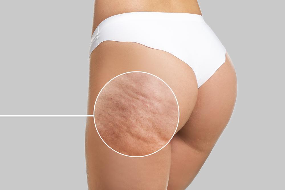 Red Light Therapy for Cellulite