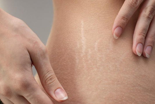 Red Light Therapy for Stretch Marks